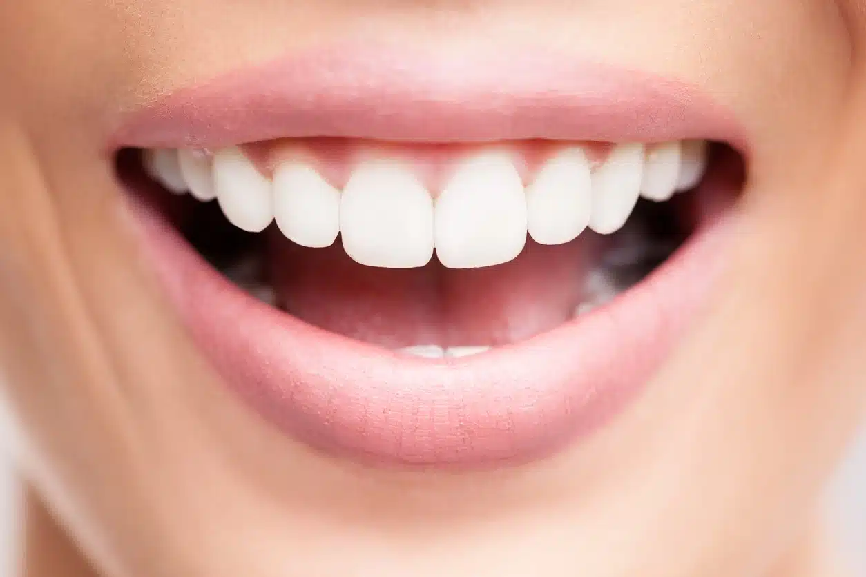 Comparaison dents jaunes/dents blanches