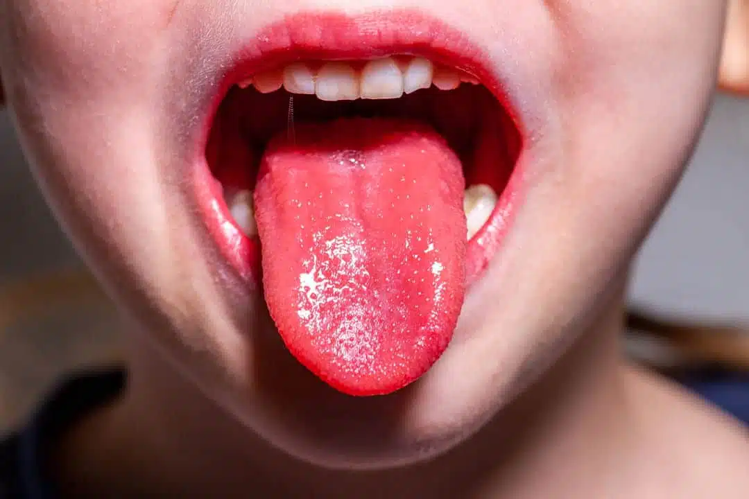 Langue rouge et lisse