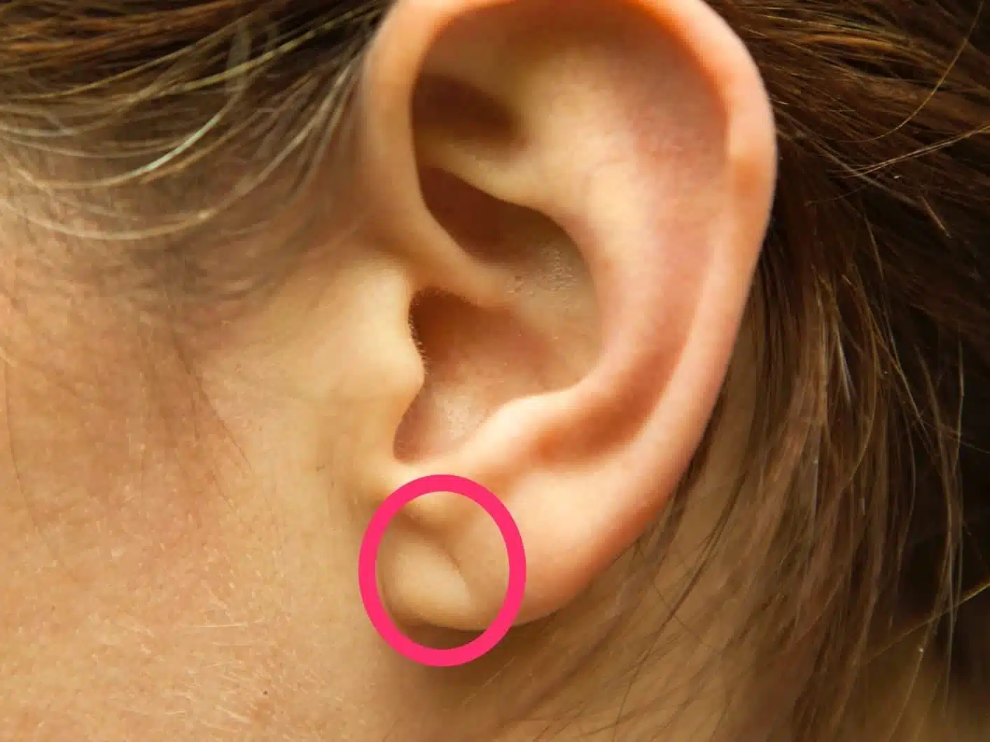 Pli diagonal sur le lobe de l'oreille