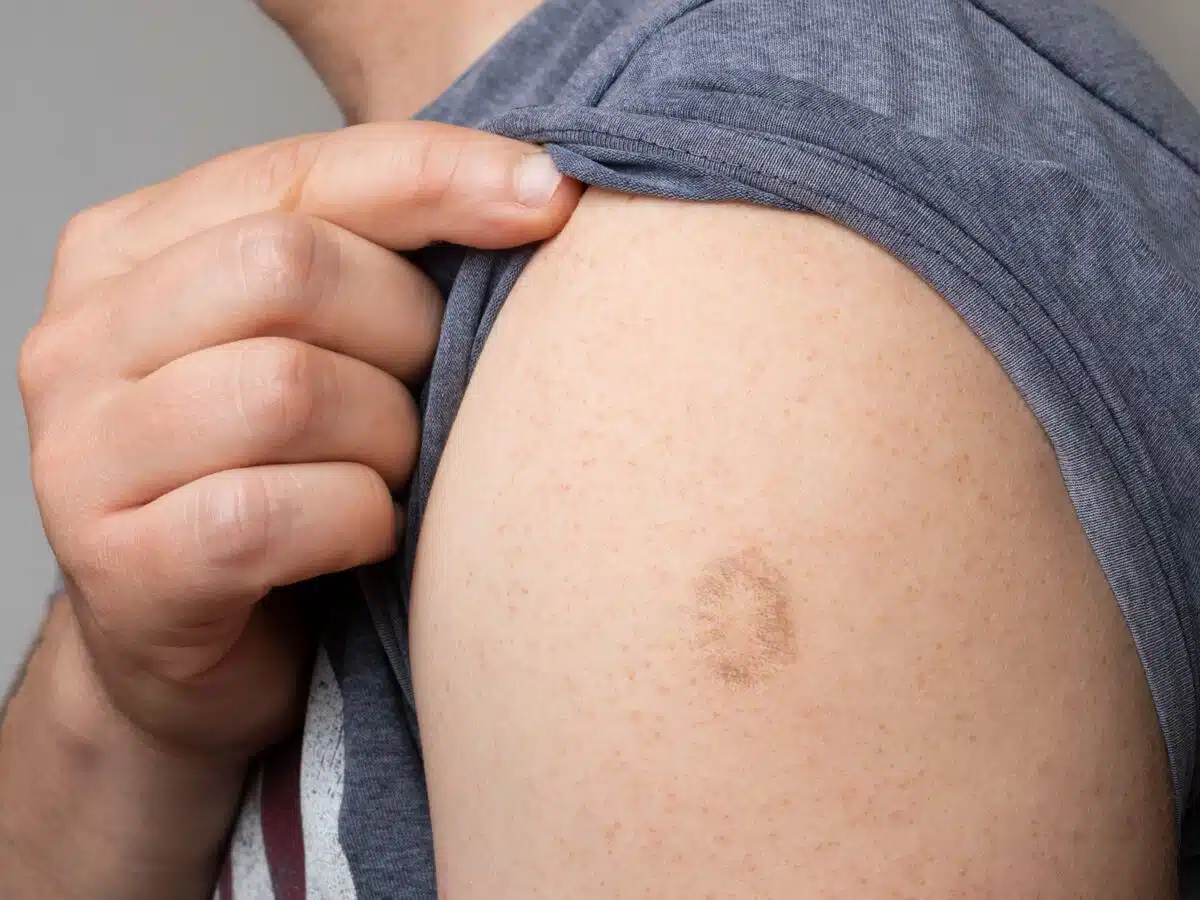 Cicatrice de vaccin contre la variole sur un bras