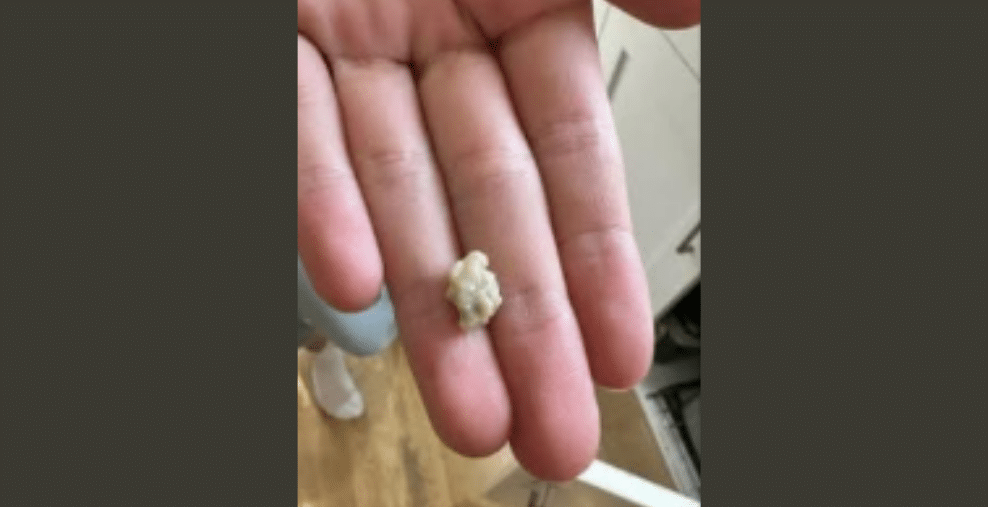 Illustration de dépôts amygdaliens