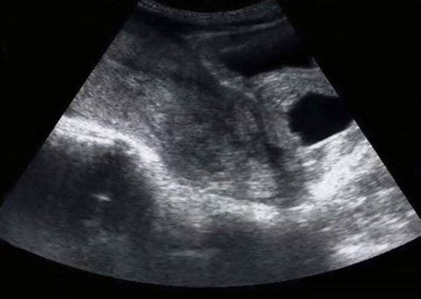 Cette jeune femme va pour une échographie et regardez la surprise qui l’attend 