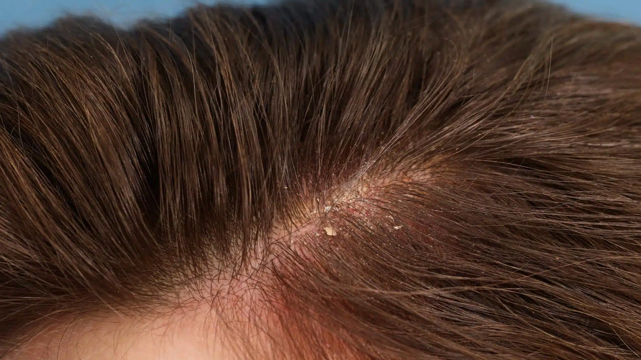 Dermite séborrhéique sur cuir chevelu