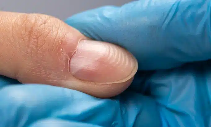 Ongles bombés