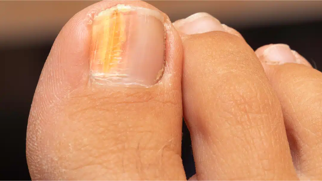 Ongles jaunis