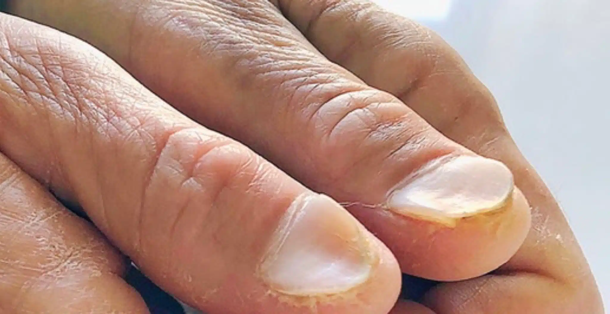 Ongles en cuillère