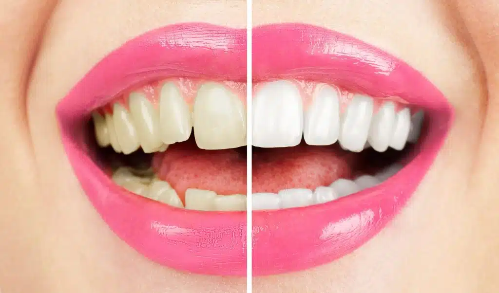 Comparaison avant/après un éclaircissement naturel