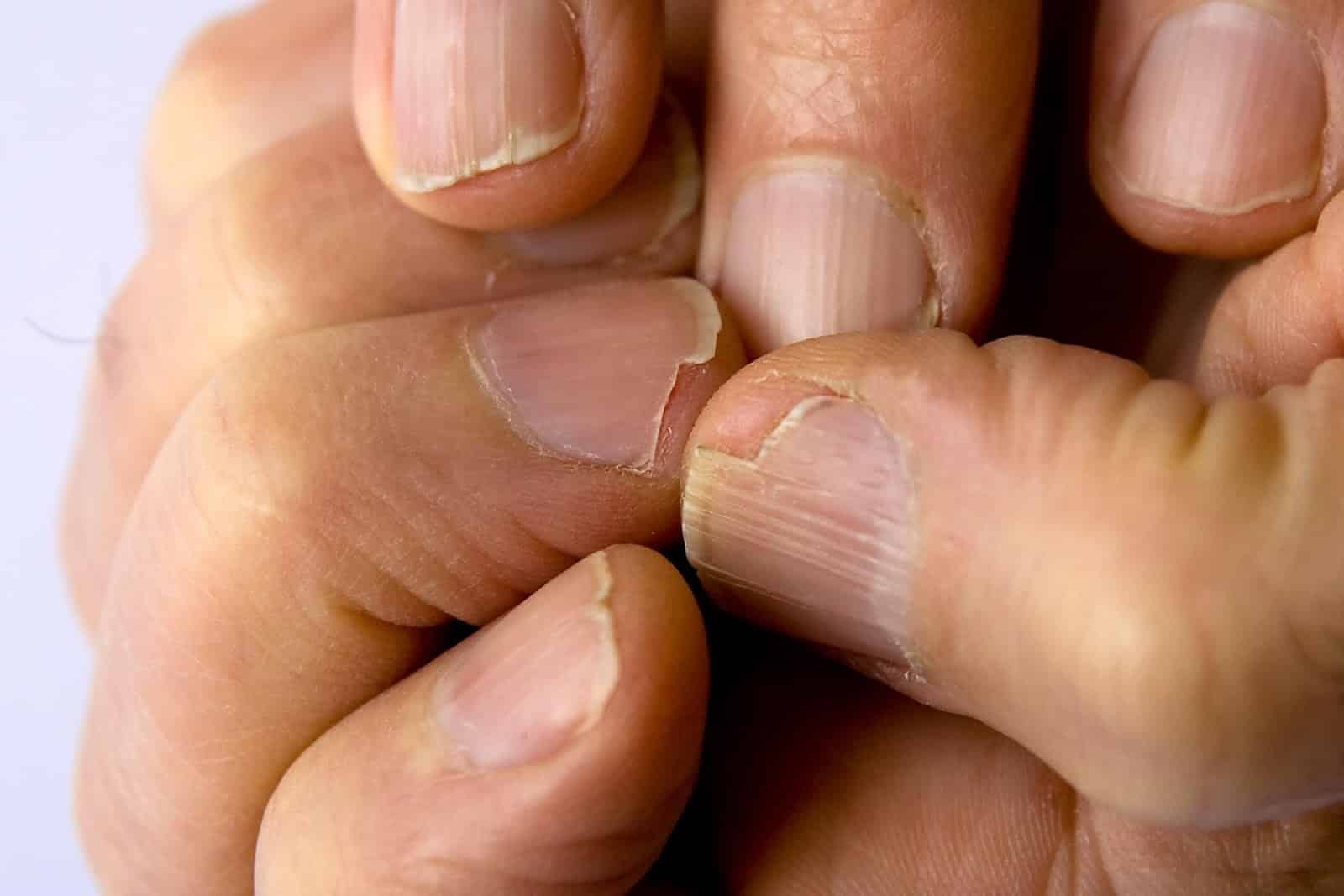 Ongles cassants et soins naturels