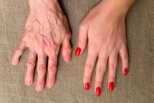 Soin des veines des mains