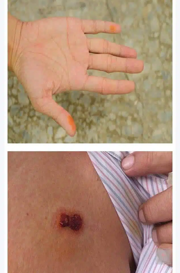 Réaction cutanée