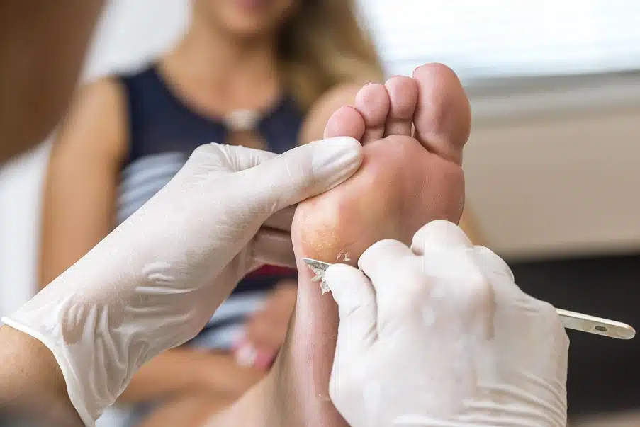 Consultation chez un dermatologue pour verrue persistante