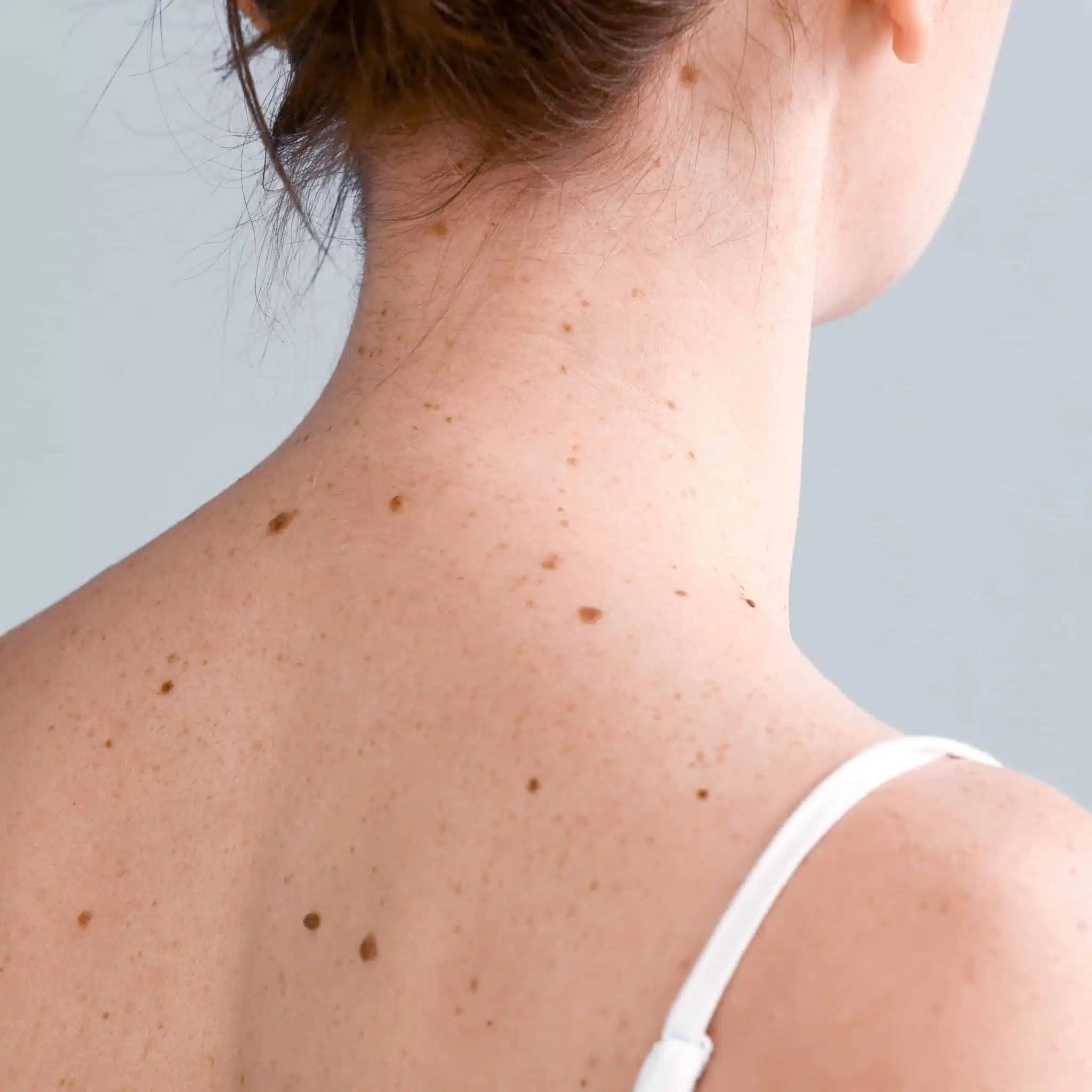 Protection solaire pour grains de beauté