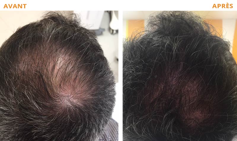 Remède contre la chute de cheveux
