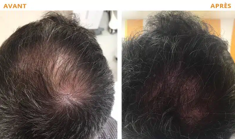 Remède contre la chute de cheveux