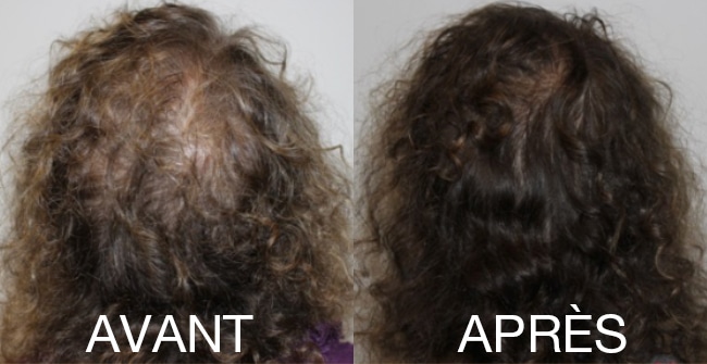 Comparaison avant/après montrant l'aspect de cheveux plus denses
