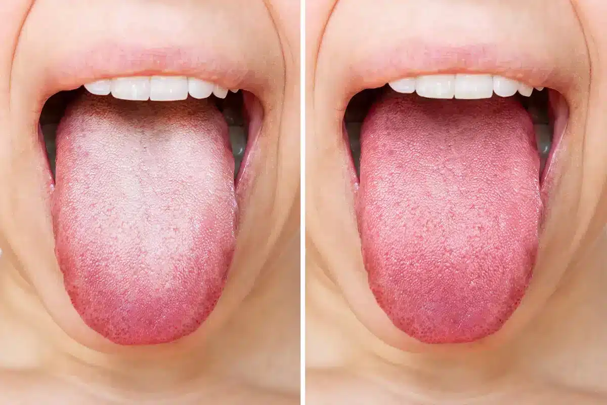Comparaison de langues saines et pathologiques
