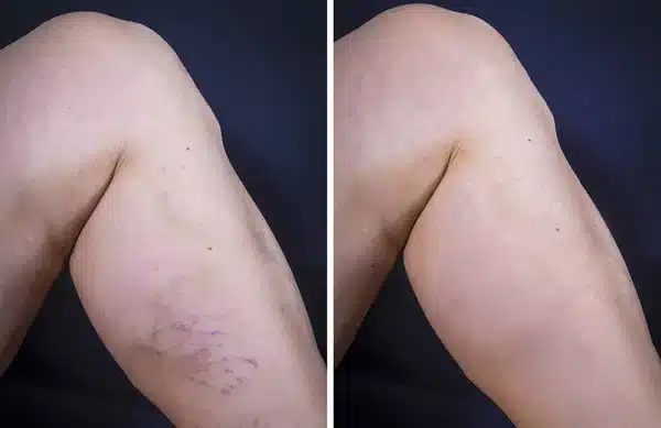 Gros plan sur une jambe présentant des varices