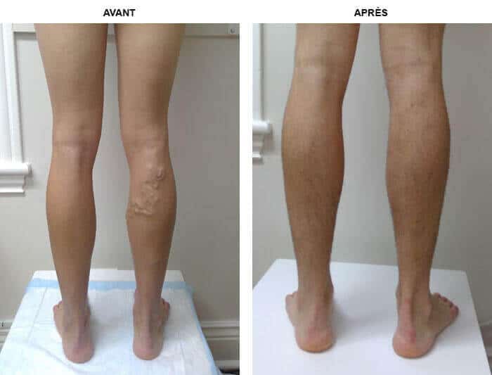 Application d'un soin sur les jambes