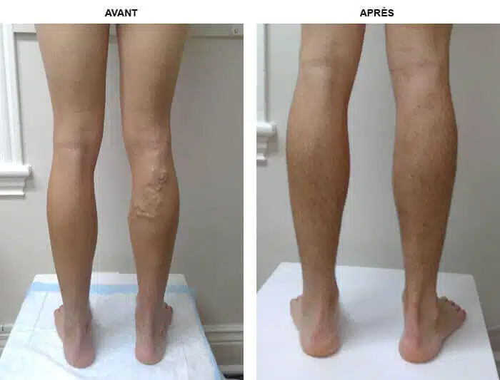 Application d'un soin sur les jambes