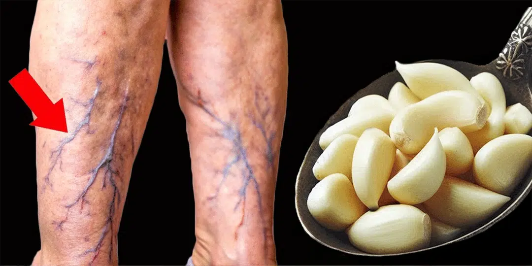 Préparation d'huile à l'ail pour massage