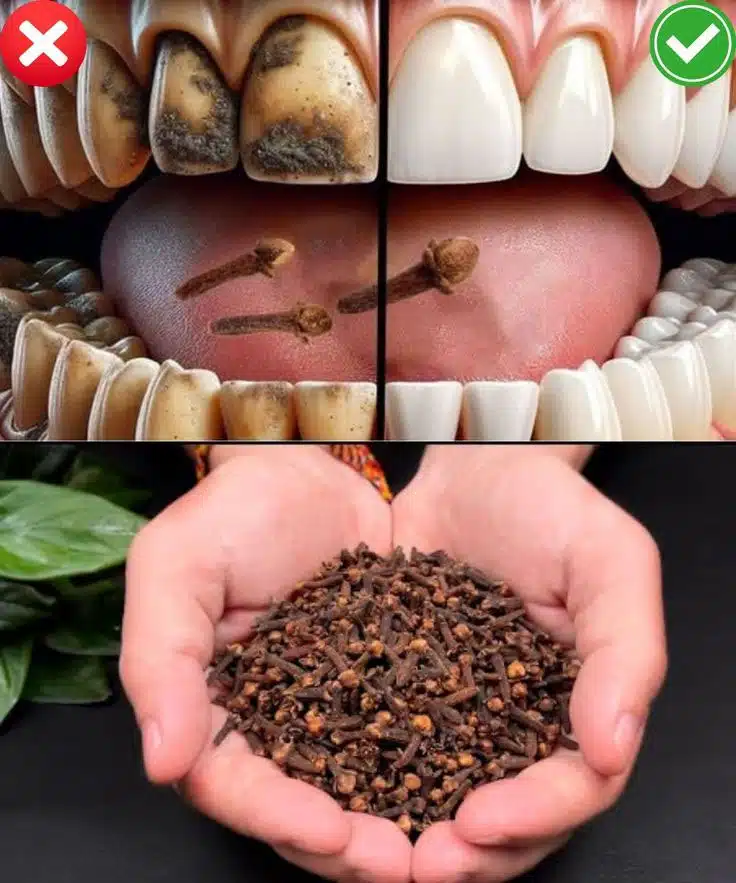 Clous de girofle, une épice aux vertus bucco-dentaires