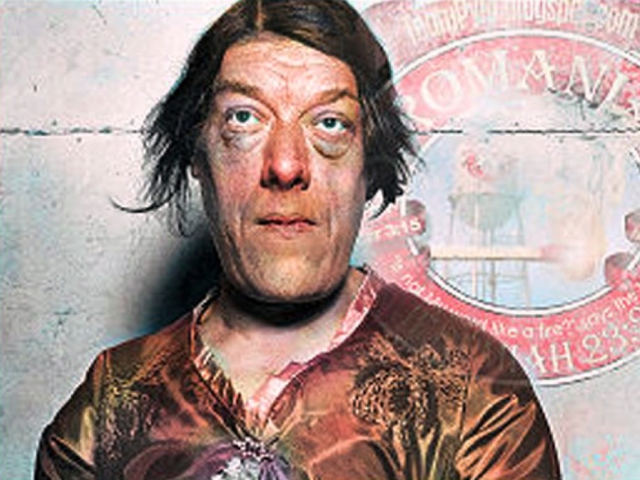 Mary Ann Bevan atteinte d'acromégalie