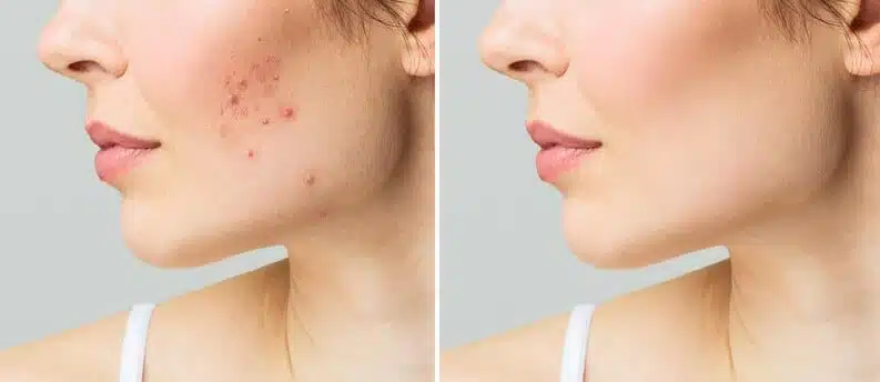 Comparaison avant/après masque maison