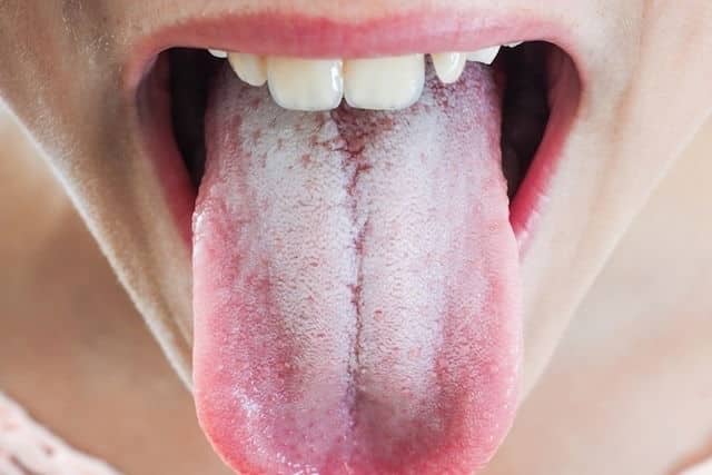 Illustration des causes d'une langue blanche