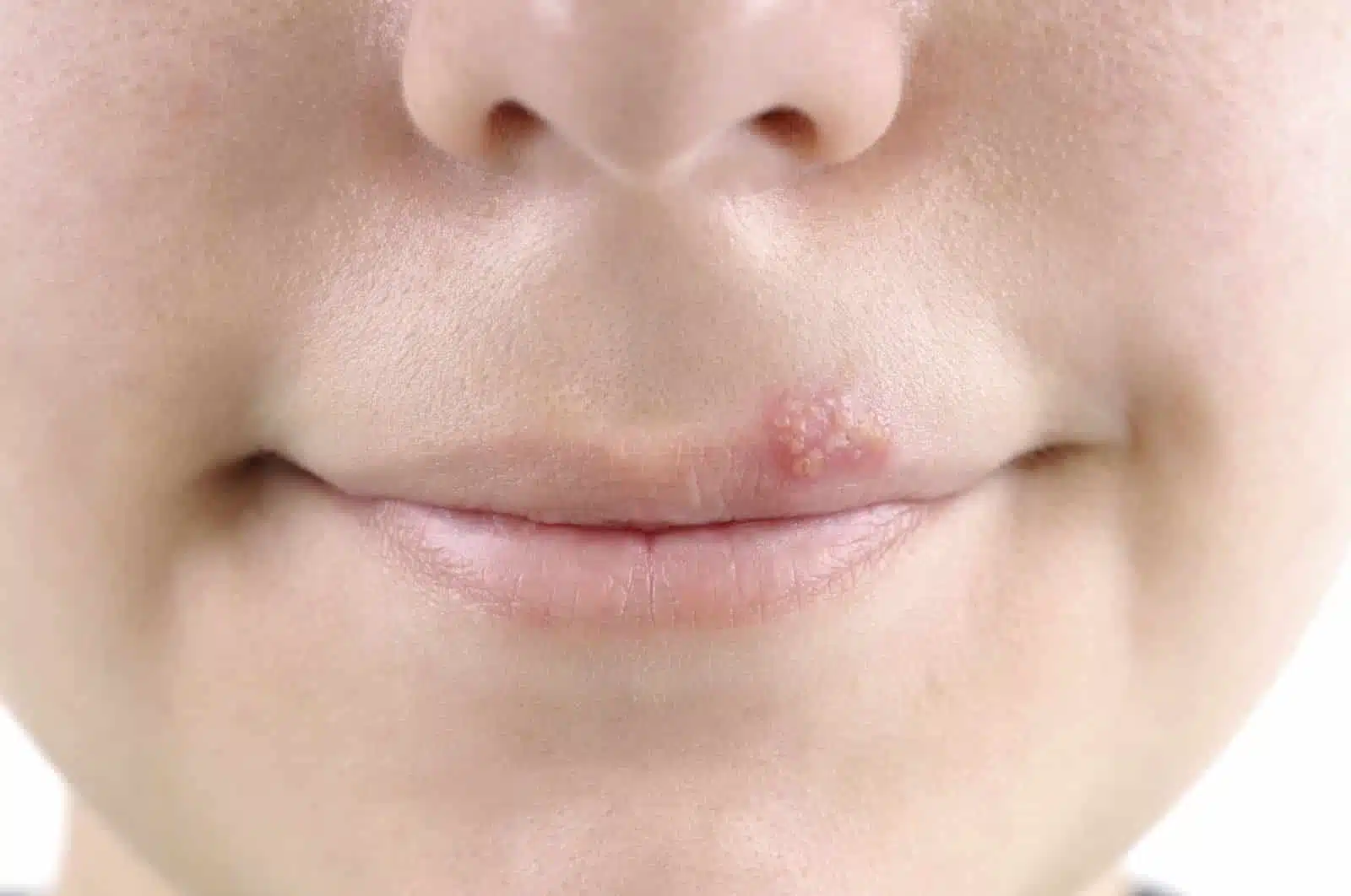 Prévention des boutons de fièvre