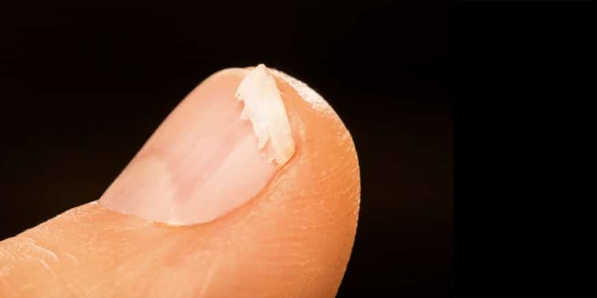 Ongles cassants