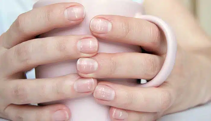 Ongles avec marques blanches