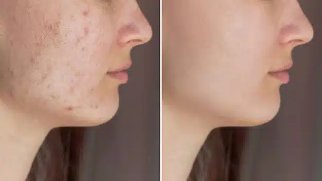 Transformation d'une peau à problèmes après soins naturels