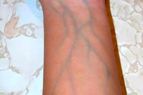 Réseau veineux visible sur l'avant-bras