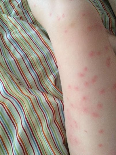 points noirs sur les jambes