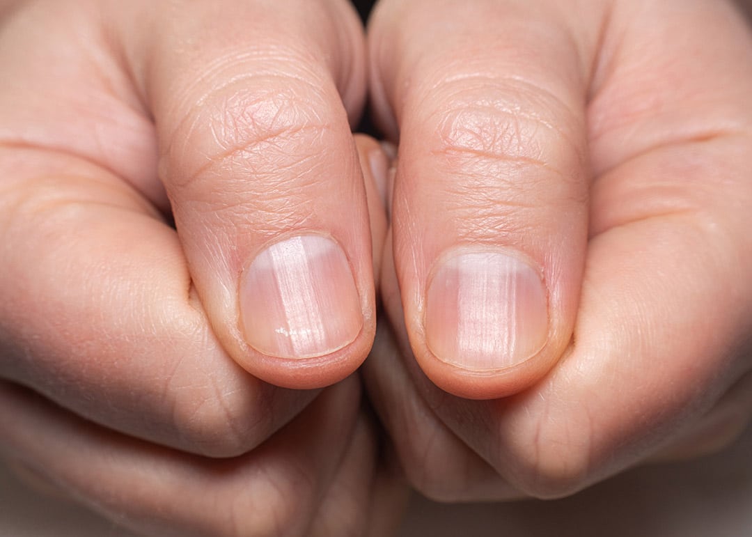 Ongles striés horizontalement