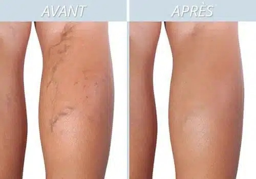 Femme massant ses jambes pour soulager les varices