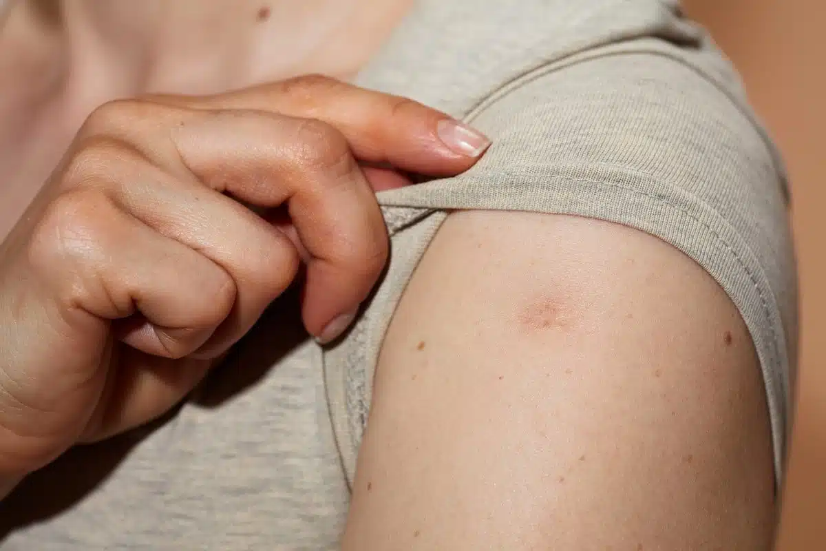 Vaccination contre la variole avec aiguille bifurquée