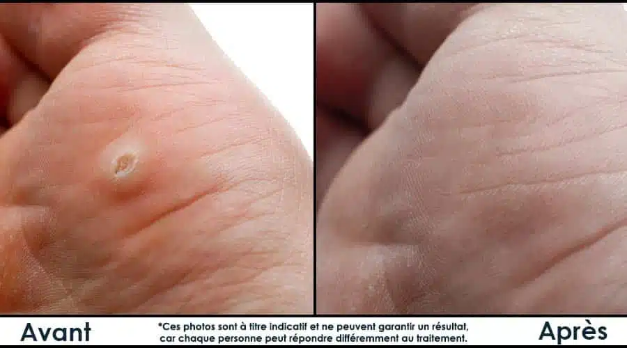 Comparaison avant/après traitement de verrue